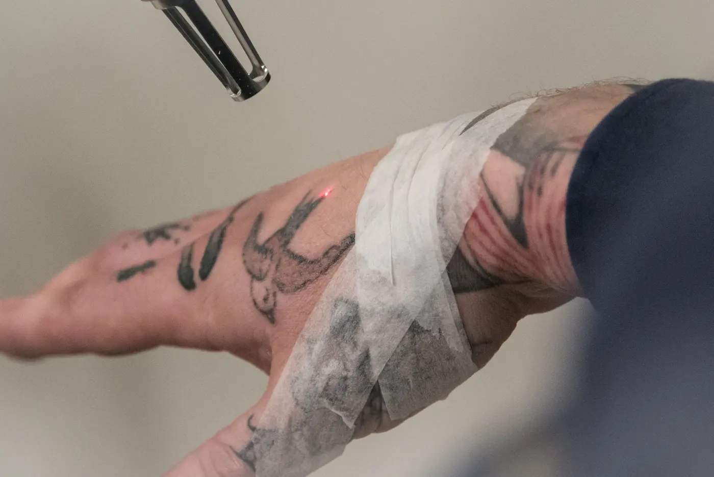 Tattoo removal treatments by Botanix Clinic