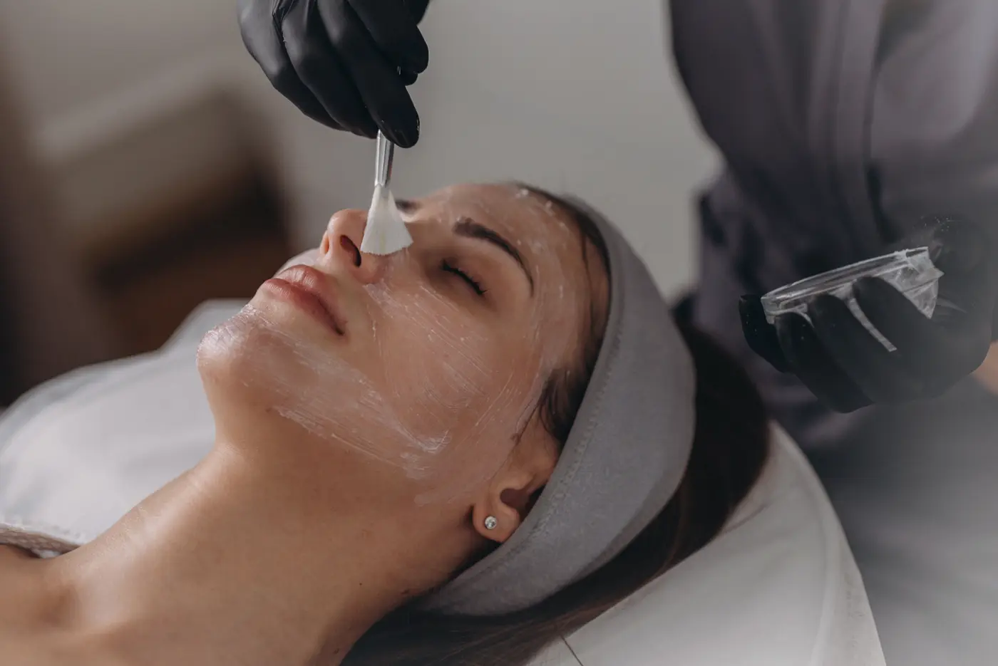 Chemical Peels